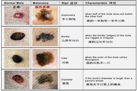 胎痣|常見胎痣分為幾種？